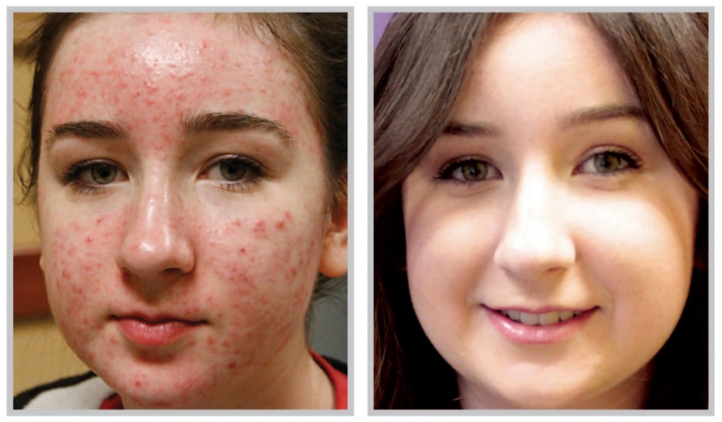 Get Rid of Acne Get Rid of Acne